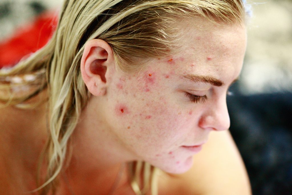 Como tratar a acne (espinha)